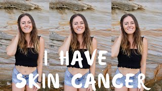 GETTING SKIN CANCER | MY STORY WITH BASAL CELL CARCINOMA