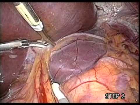 腹腔鏡下肝外側区域切除術　STEP 2　肝の授動と肝切離