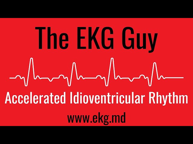 Accelerated Idioventricular Rhythm EKG l The EKG Guy - www.ekg.md class=