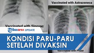 Apa Efek Samping Vaksin Sinovac untuk Covid-19 - Tirto Kilat