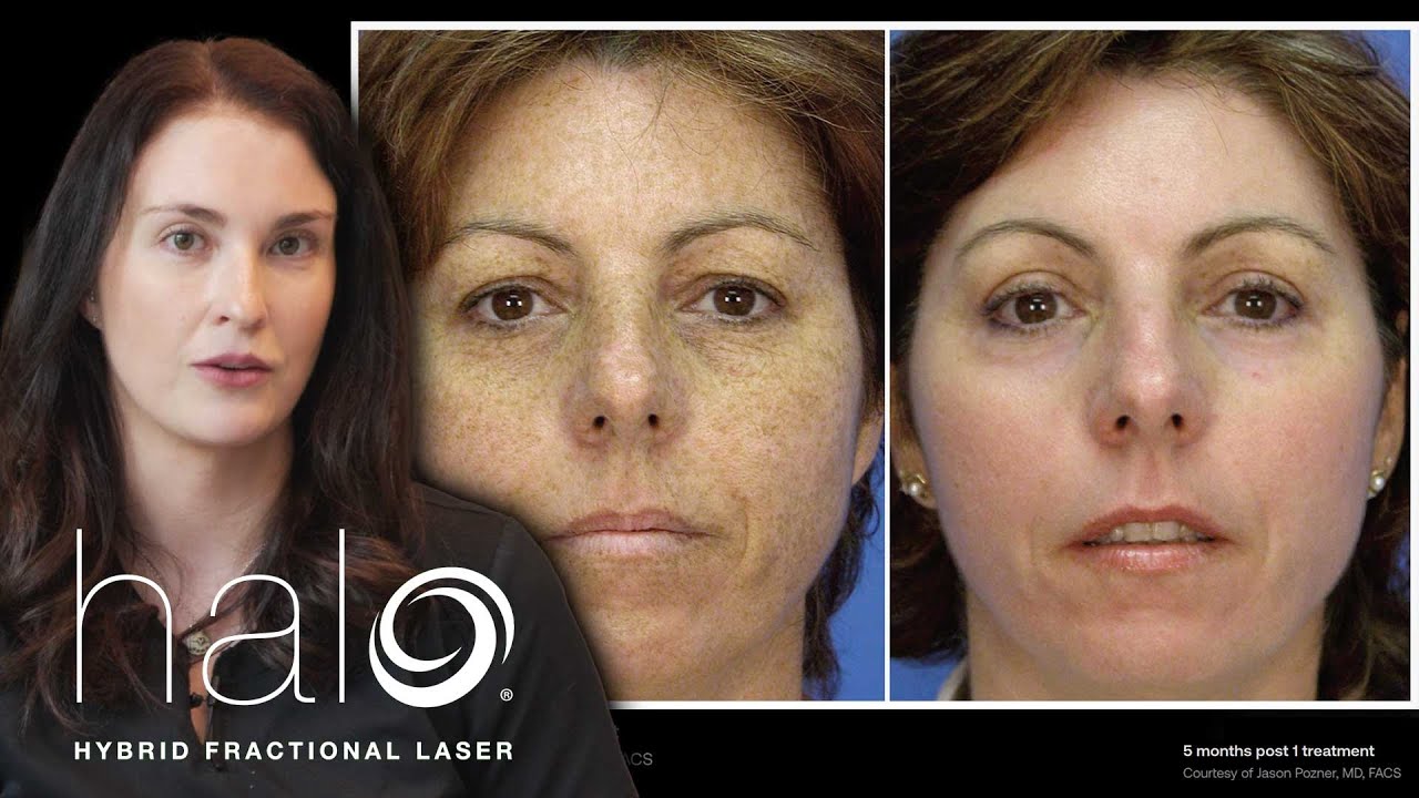 Revive Your Skin: Halo Laser Solution for Sun Damage