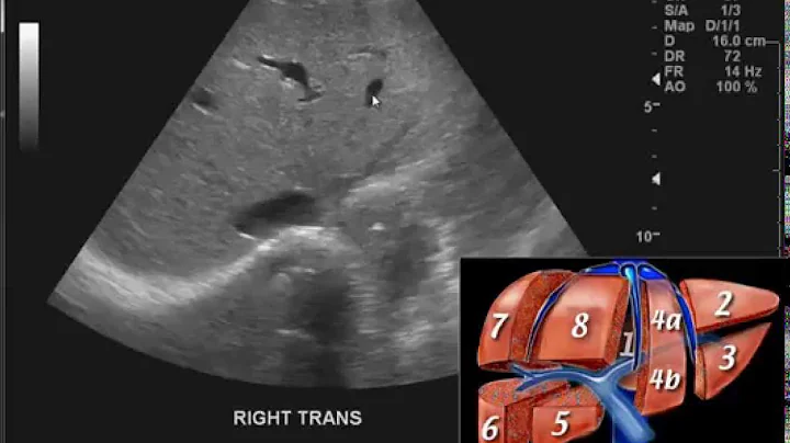 Introduction to the interpretation of Abdominal Ultrasound