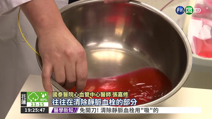 免開刀! 清除靜脈血栓用"吸"的 - 天天要聞