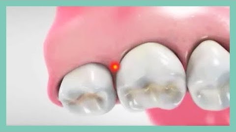 The Wand Intraligamentary Injection Tutorial