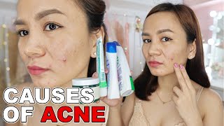 UGLY TRUTH Behind ACNE BREAKOUT + How To Get Rid of Pimples