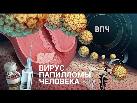 Все о вакцинации от вируса папилломы человека (ВПЧ)