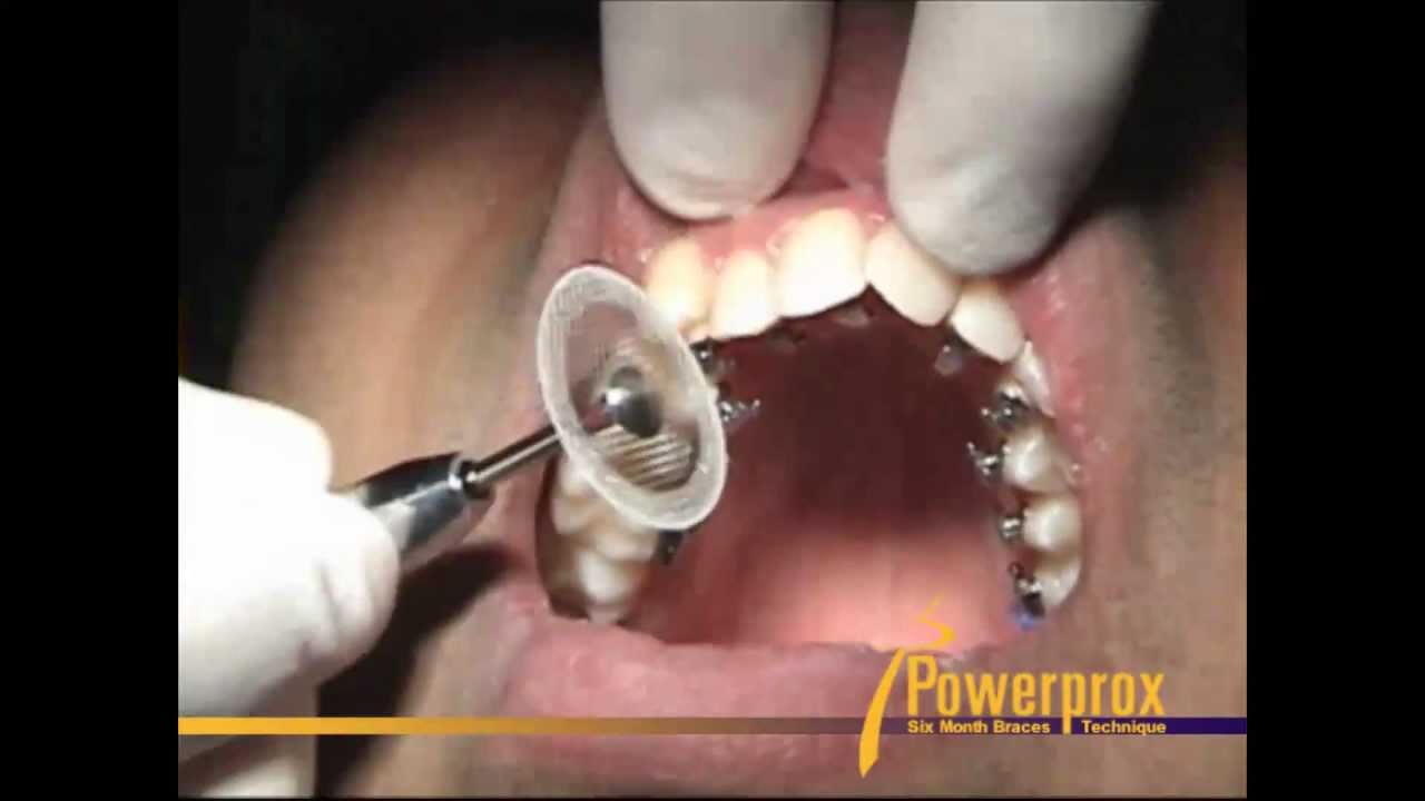 How to Reprox or IPR 2 Powerprox Six Month Braces Orthodontic Education