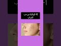 خل التفاح للوجه ونتيجته الجباره ع البشرة العناية Skincare Shorts اكسبلور خل التفاح للوجه ونتيجته الجباره ع البشرة العناية Skincare Shorts اكسبلور