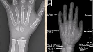 Age Determination From Ossification of Bones