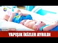 Yapışık ikizler ayrıldı