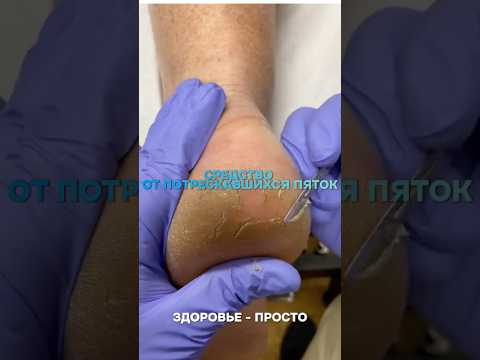 Больше полезных рецептов для здоровья по ссылке в профиле #здоровье #зож #рецепт #пятки #польза
