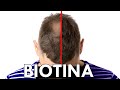 BIOTINA para el PELO explicado por MÉDICO: ¿FUNCIONA?