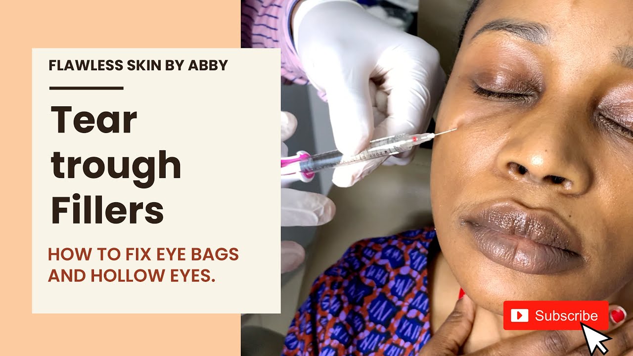 Tear trough Fillers How to fix eye bags and hollow eyes. YouTube