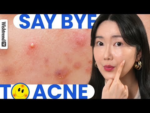 [Full] Have Acne Prone Skin? We had them, too! | Acne Self Care at Home