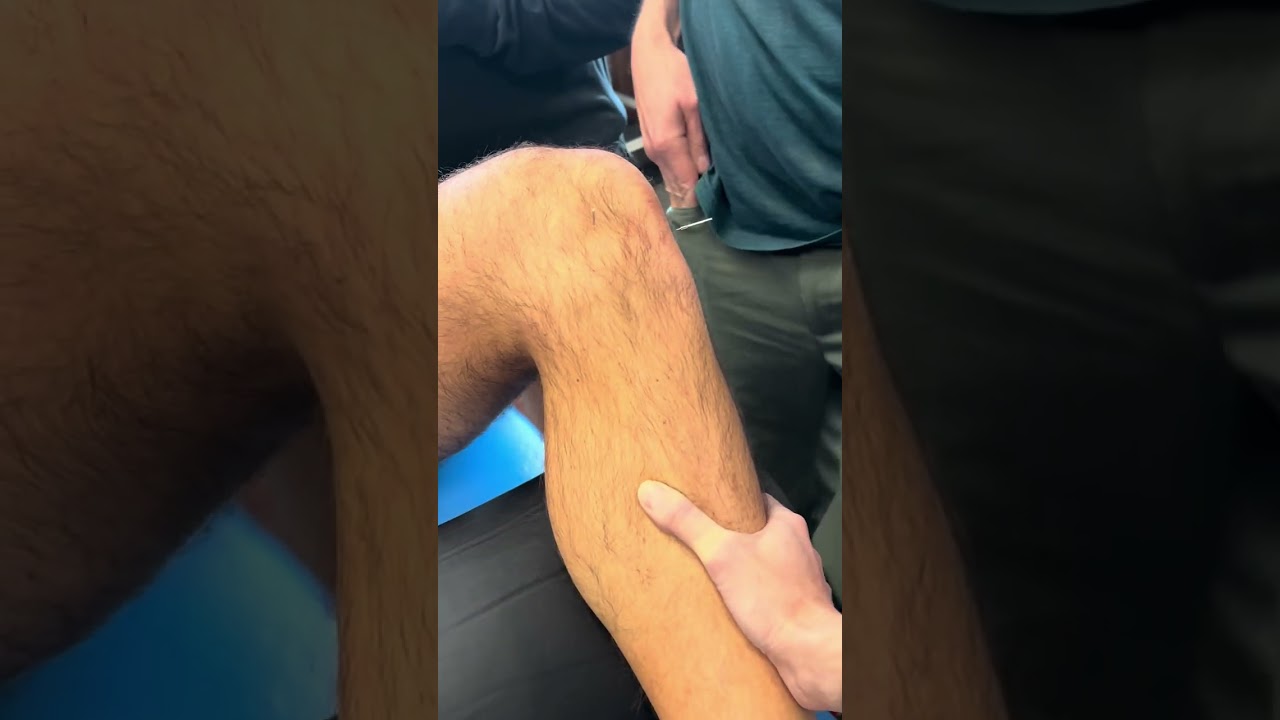 Dry Needling Meniscus Treatment