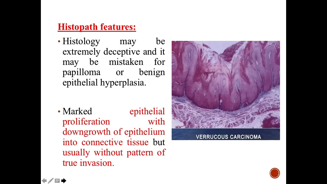 BDS 303. VERRUCOUS CARCINOMA BY DR. ANKITA SINGH