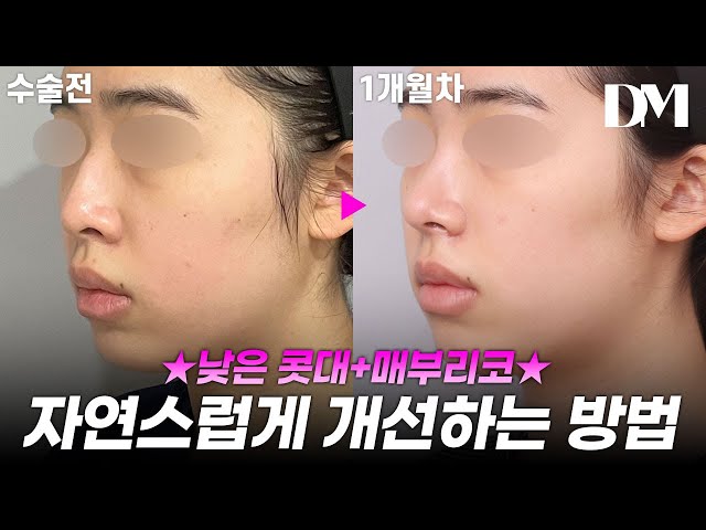 [눈,코성형] 자연스럽게 코 높아지는 방법!? #눈성형 #코성형 #뒷트임