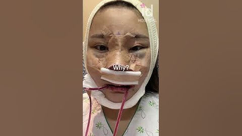 Plastic surgery transformation in Korea #idhospital #shorts