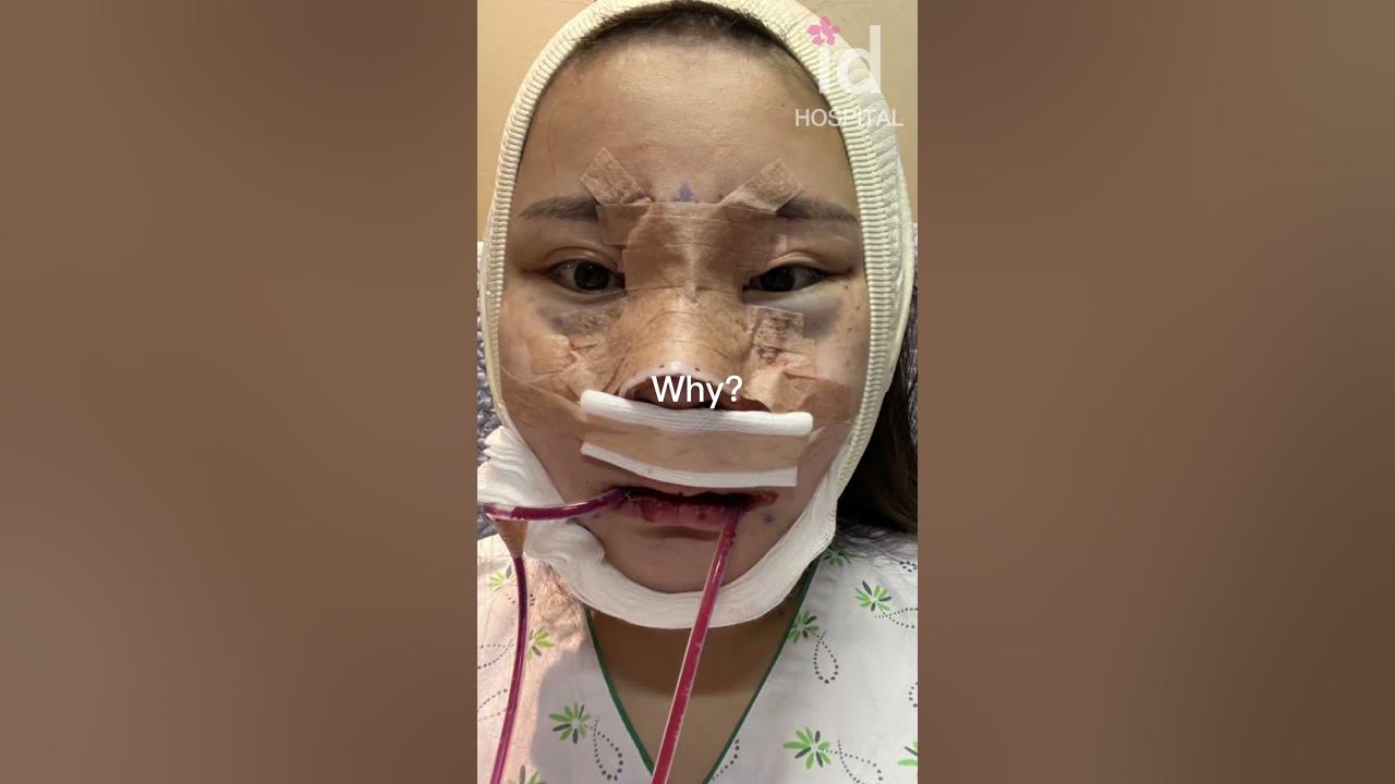 Plastic surgery transformation in Korea #idhospital #shorts