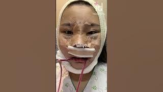 Plastic surgery transformation in Korea #idhospital #shorts