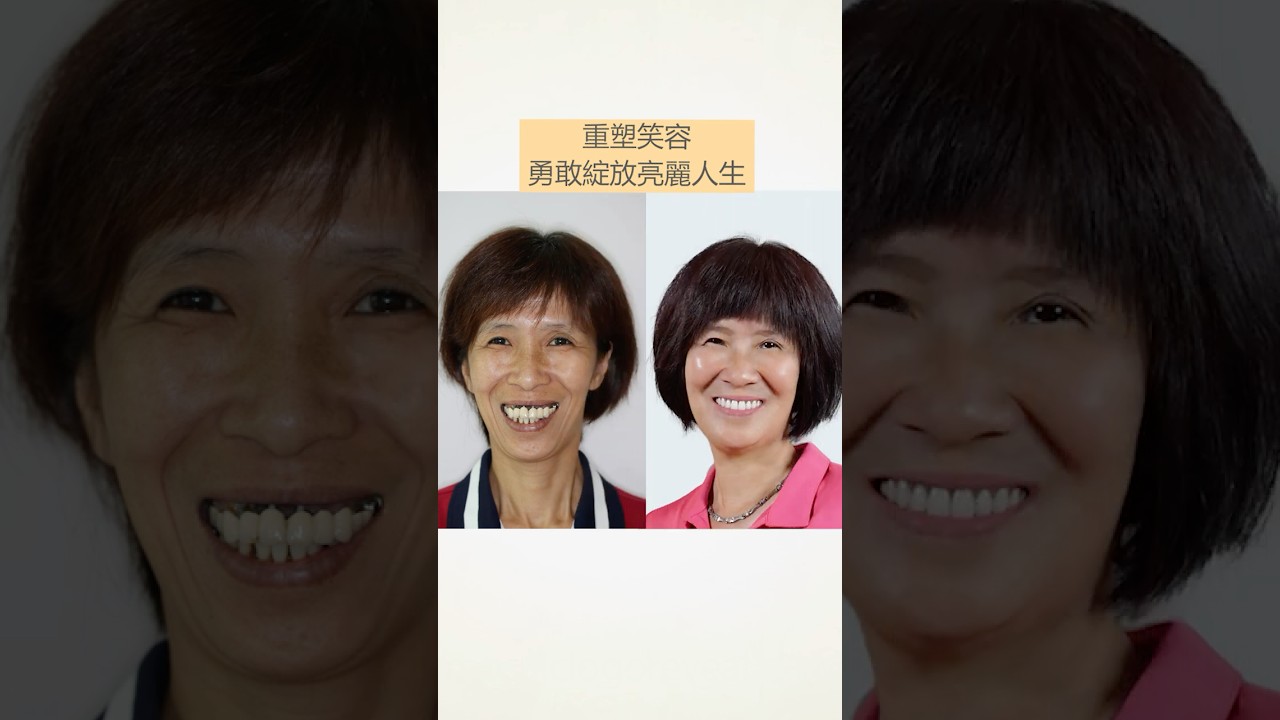 再度擁有的喜悅，不知道多久不曾有過的感覺...   #一日全口重建 #Allon4 #Allon6  #高壓氧植牙專利擁有 #高壓氧植牙#Zygoma顴骨植牙 縮圖