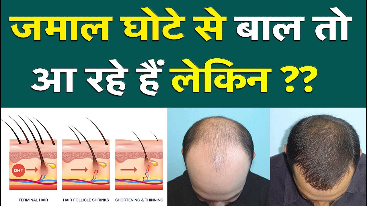 जमाल घोटे से बाल तो आ गए लेकिन ? Dr Prateek Chauhan