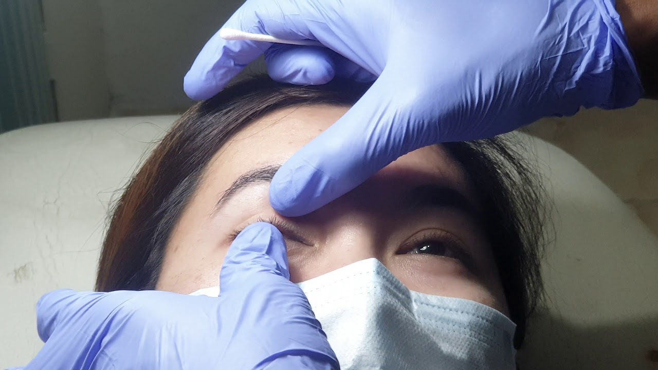 Eye parasite removal YouTube