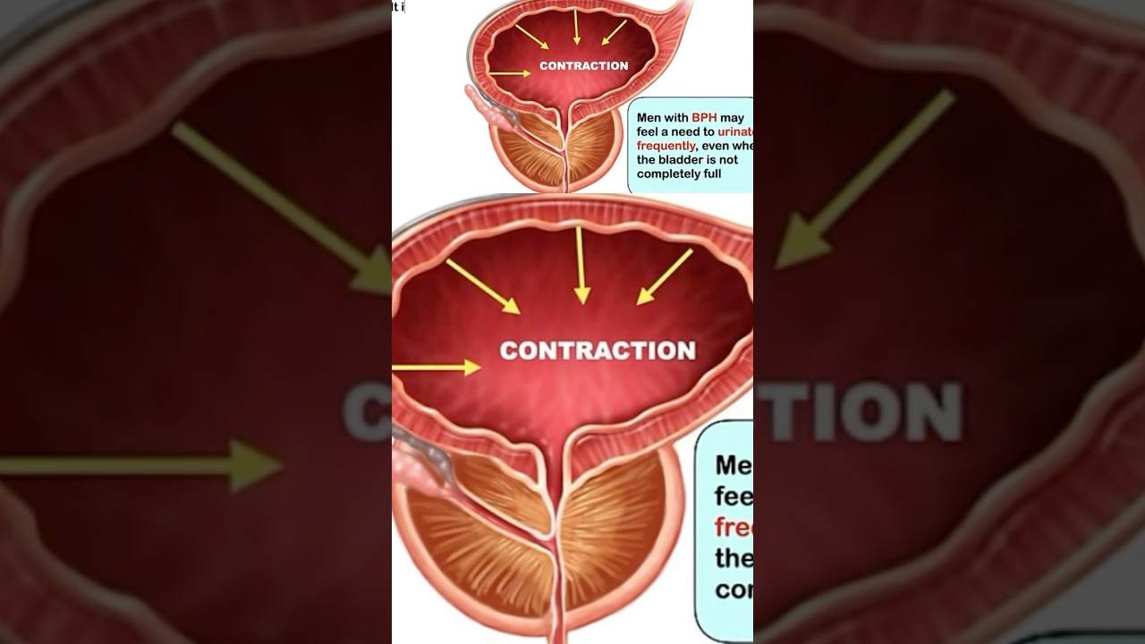 Prostate enlargement symptoms. 