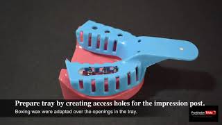 Impression Techniques for Implant Dentistry   Step by Step Open tray Impression technique