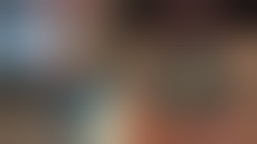 #74 MSICS in Post-Uveitic Cataract; Small 2mm Pupil, Stretch Pupilloplasty #DrPrateekJain