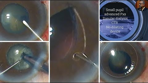 Not just another Small Pupil Phaco- Unedited surgery -PXS -Zonular dialysis   CTR- no pupil device.