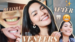 [Vlog #6] My FULL Veneers Experience with CAD CLINIC!! + What You Need To Know  • Joselle Alandy