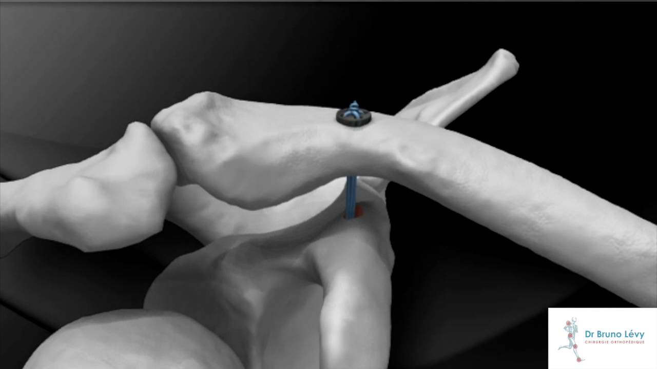 Dr Bruno Lévy - Traitement arthroscopique des disjonctions acromio-claviculaires