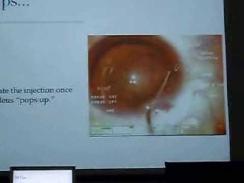 Basic phaco - Divide and conquer 1