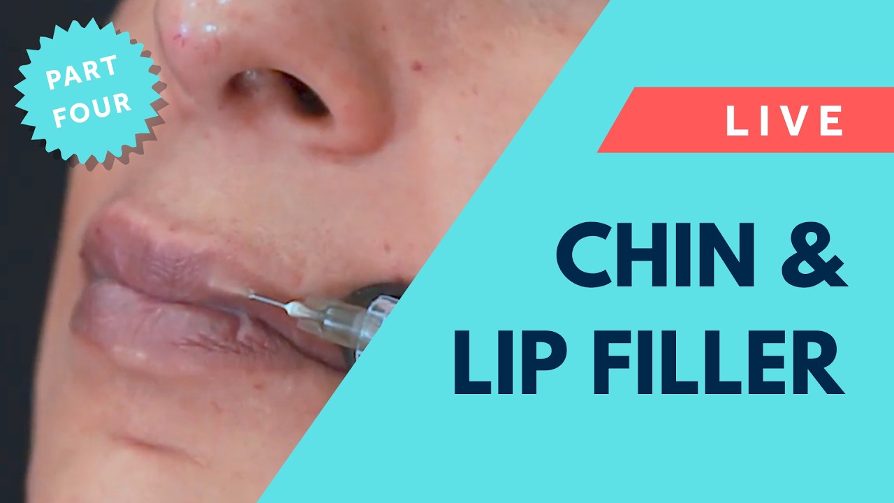 Live Chin & Lip Filler: Final Steps in Gabriella’s Full Face Journey 💎 GEM©️ by Harley Academy