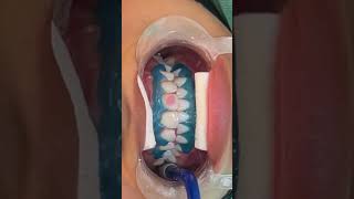 تبييض الأسنان بالليزر في عيادة الأسنان