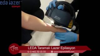 Leda Epilasyon Trabzonda Sadece Çapar Estetik Clinicte