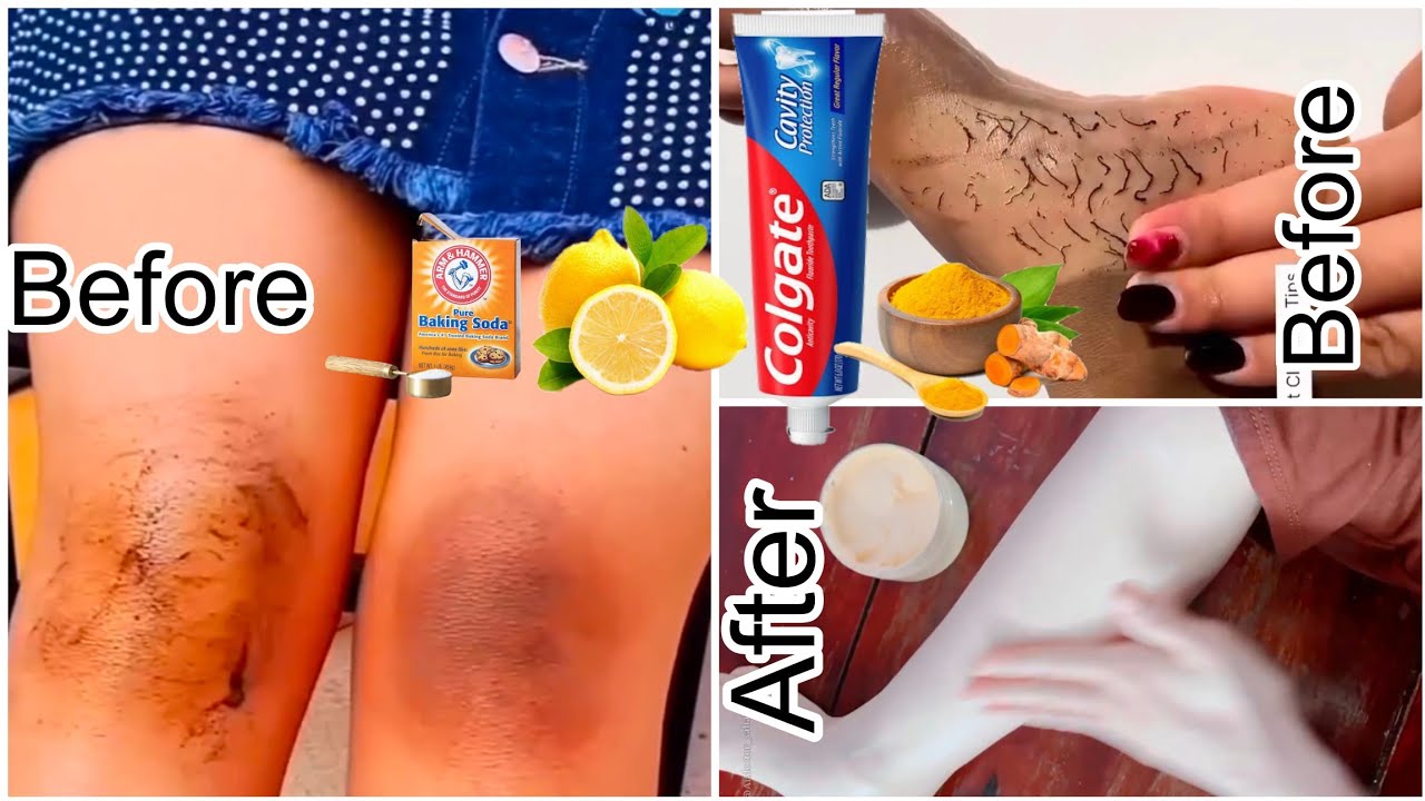 Parmanently Dark knee removal pack / clean feet Dirt and Tanning instant fairness skin 💯 result