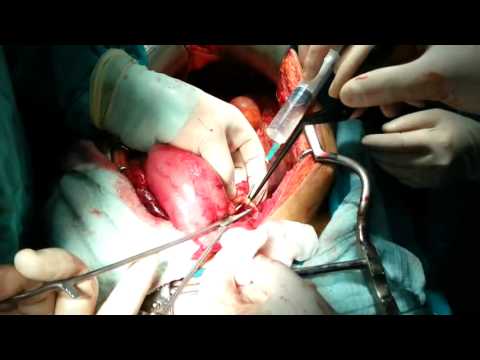 BAĞIRSAK KANSERİ AMELİYATI İZLE - OP.DR.SELÇUK ARSLAN