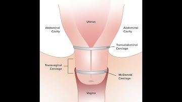 Cerclage from Ultracondensed course MRCOG part 2