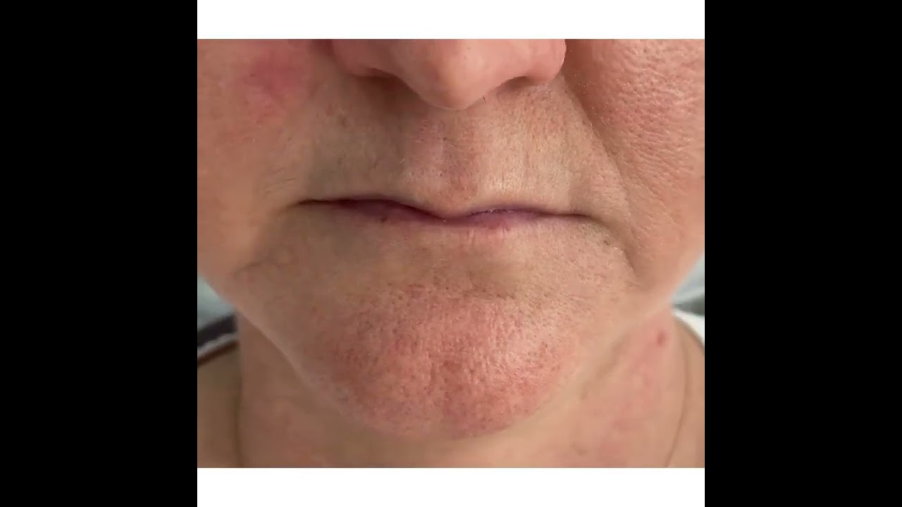 Preenchimento labial é muito mais amplo do que você imagina, pela Dra Luana Furtado Mussuly.