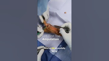 Left First Toe Amputation - Cadaver Edition #orthopedic #doctor #toe #medicine #hospital #watch #OR