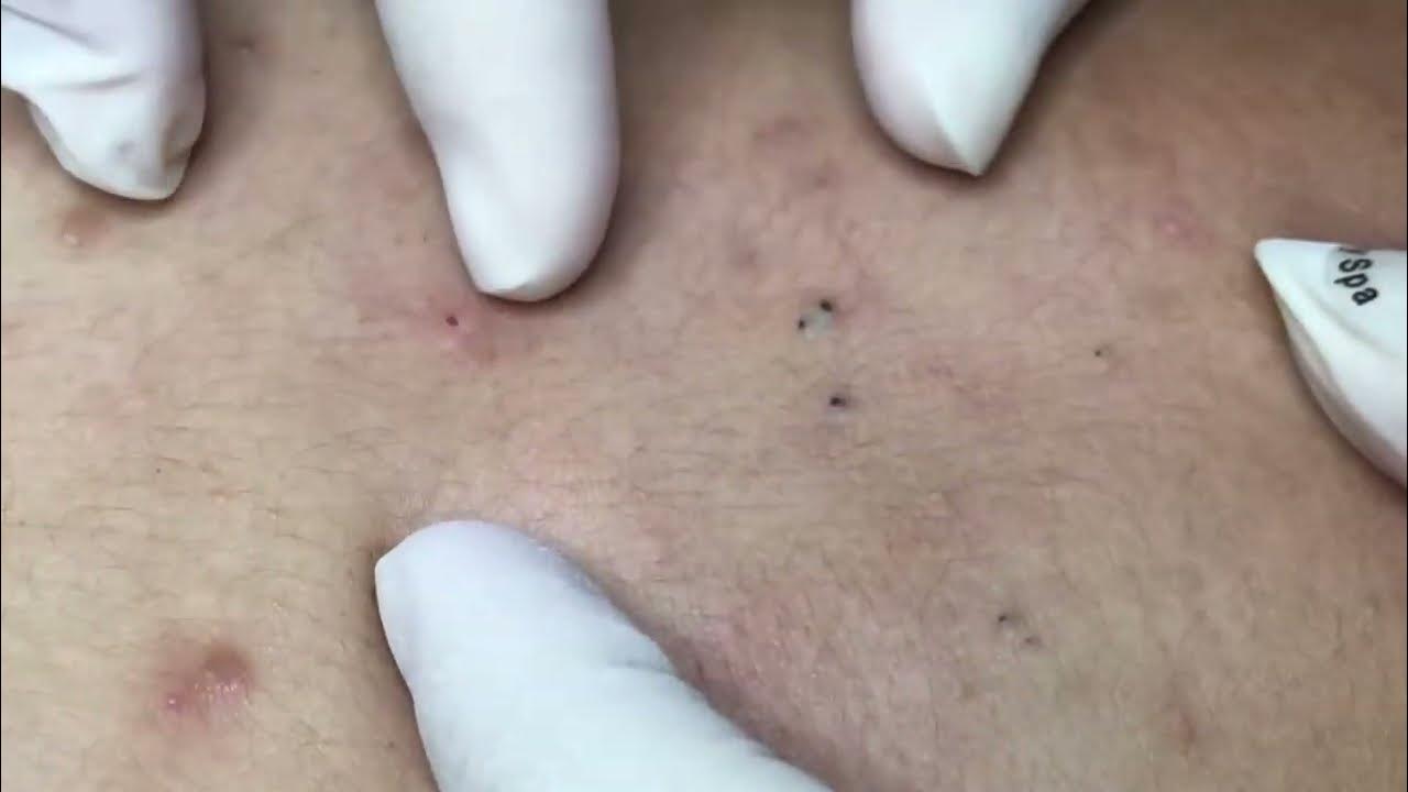 How to Get Rid of Blackheads for Good Dermatologist Tips Acne