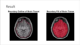 Digital Signal Processing - Mini Project - Brain Segmentation from MRI Scan