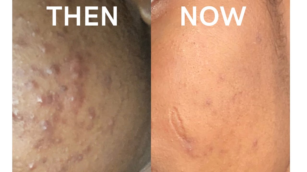 HOW I CLEARED MY CYSTIC ACNE + product review on the panoxyl acne wash