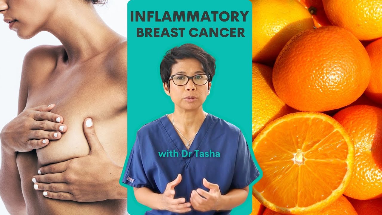 A Rare Type Of Cancer Inflammatory Breast Cancer With Dr Tasha A Rare Type Of Cancer Inflammatory Breast Cancer With Dr Tasha