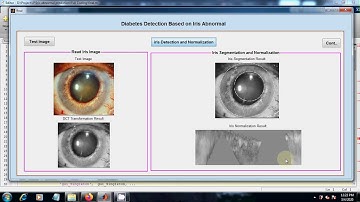 Diabetes Detection based on Iris abnormal | Matlab Image Processing Final Year Project