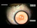 Live Surgery by Dr Gaurav Luthra