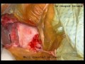 Cochlear implant surgery by dr.deepak dalmia 26 1 2016(Aud.Tewfiq Siliman Herini - Erbil-Kurdistan)) tewfiqsiliman@yahoo.com 009647504485973