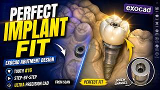 Custom Abutment Design #16 🦷 Exocad Step-by-Step | Implant Workflow